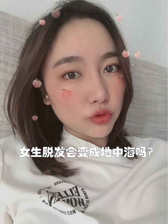 植发科普女生脱发会变成地中海吗