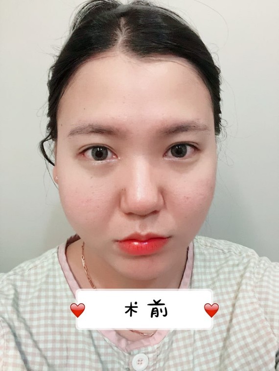 说起经历也够坎坷的,.我年纪就不曝了,不是很大,但是脸上就是肉很多