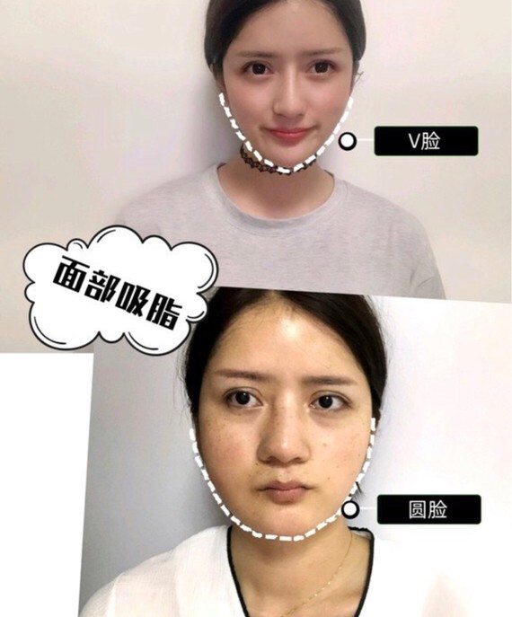 面部提升