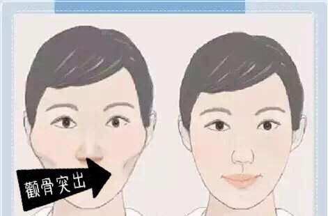 郑州市 149篇日记 【颧骨颧弓整形术】【公立三甲】颧骨缩小/降低