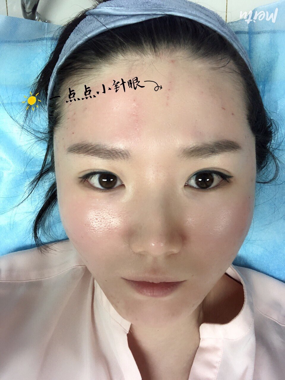 继续聊聊水光补水,今天给大家科普一下水光手针注射91,_圈子-新氧