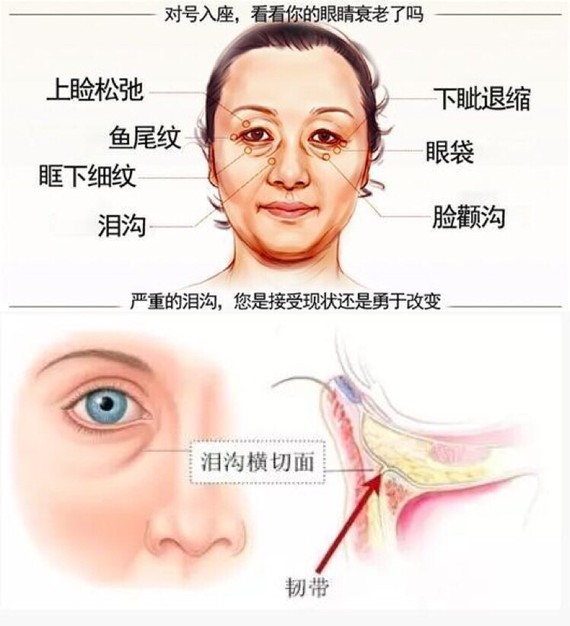 自体脂肪填充眼周抗衰(4)--泪沟填充