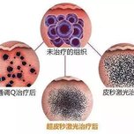 【黄褐斑是怎样形成的】黄褐斑是一种后天性色素增加性皮肤病,发病与