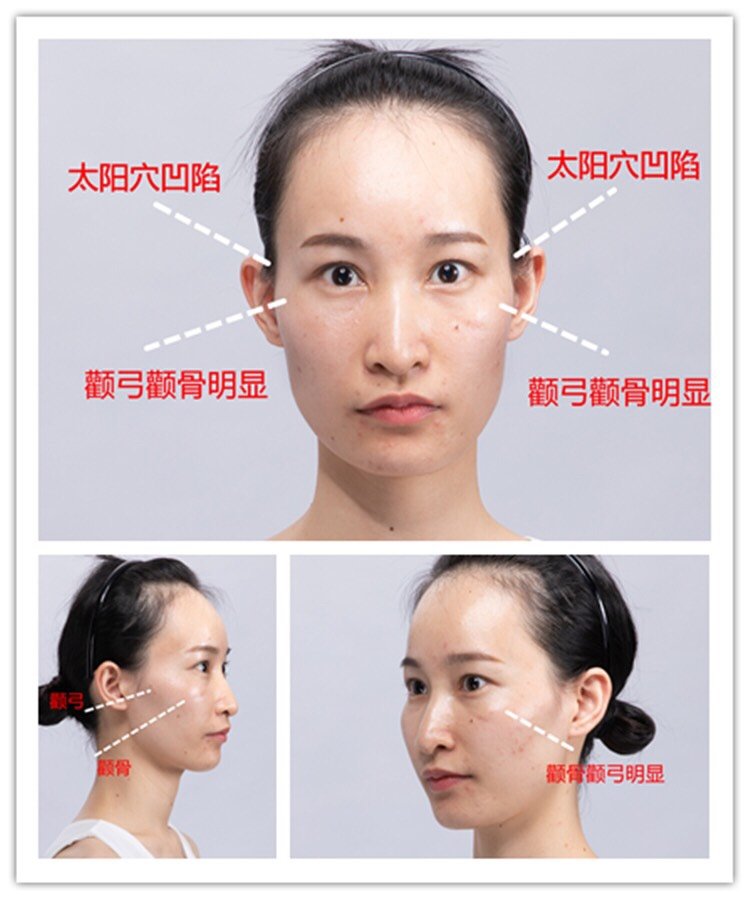 92觉得颧骨宽71外扩71高71别急着做内推术,其实80%_圈子-新氧