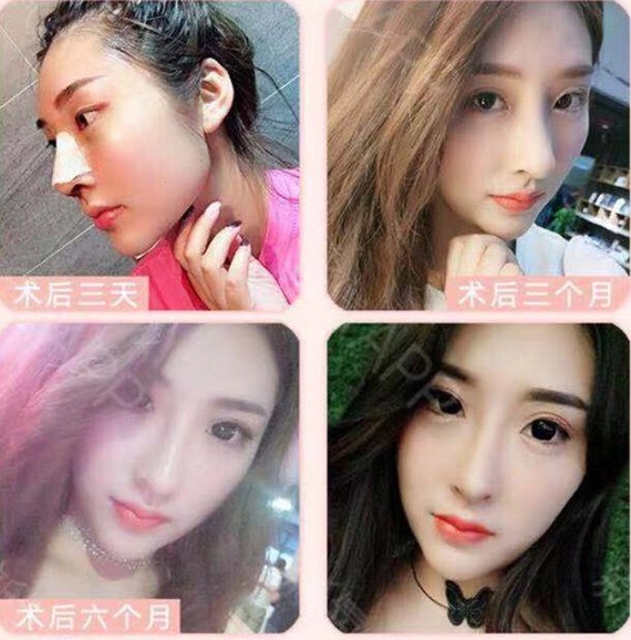 科普|什么是和平超体隆鼻?你想了解吗?