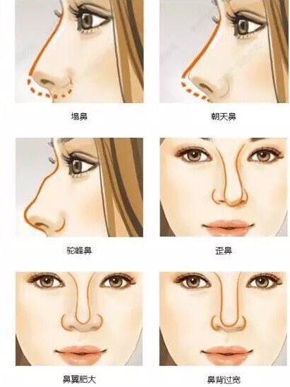 肋软骨隆鼻取肋软骨的切口多大?