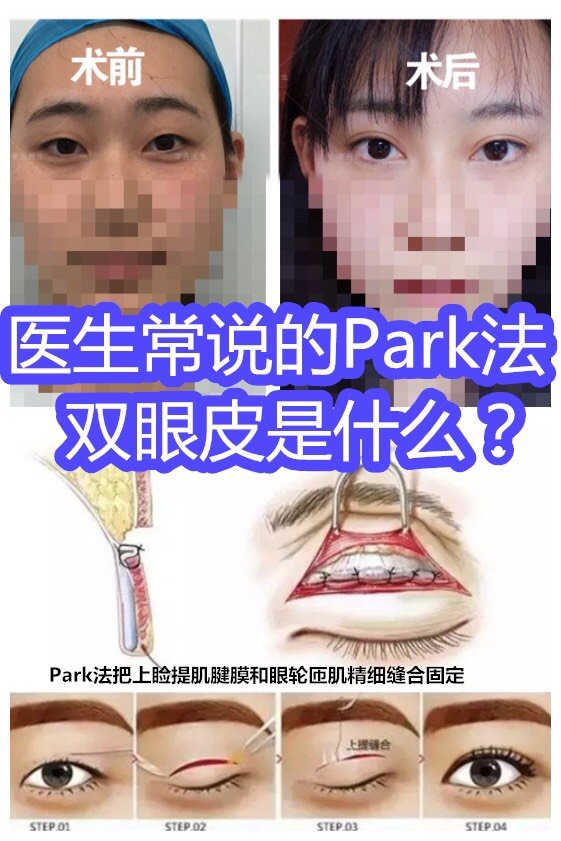 医美小课堂#park法双眼皮是什么?