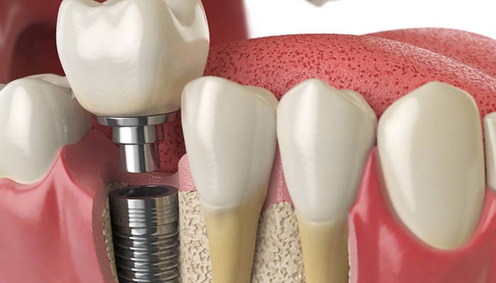 种植牙和传统镶牙相比有哪些优势?
