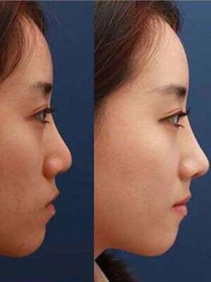 鼻基底会影响鼻部的高度,是面部中部核心的位置,如果鼻基底凹陷,整个