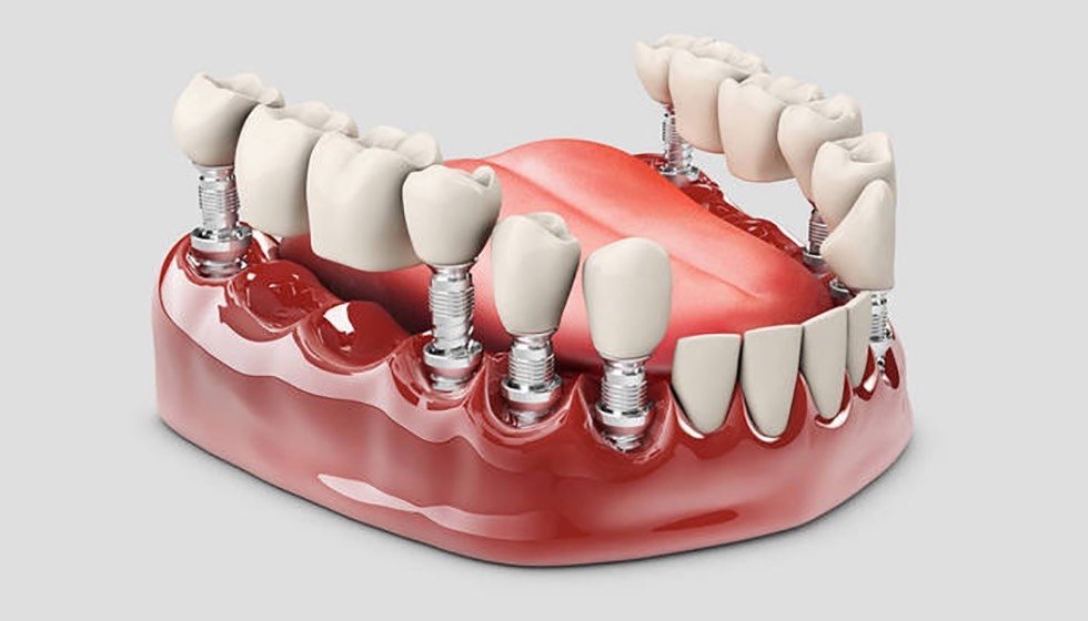 传统镶牙主要有固定义齿修复和可摘义齿修复.