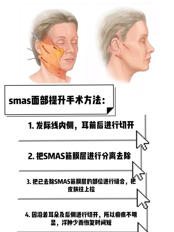 最近正时兴的smas筋膜全脸提升,到底有多神奇