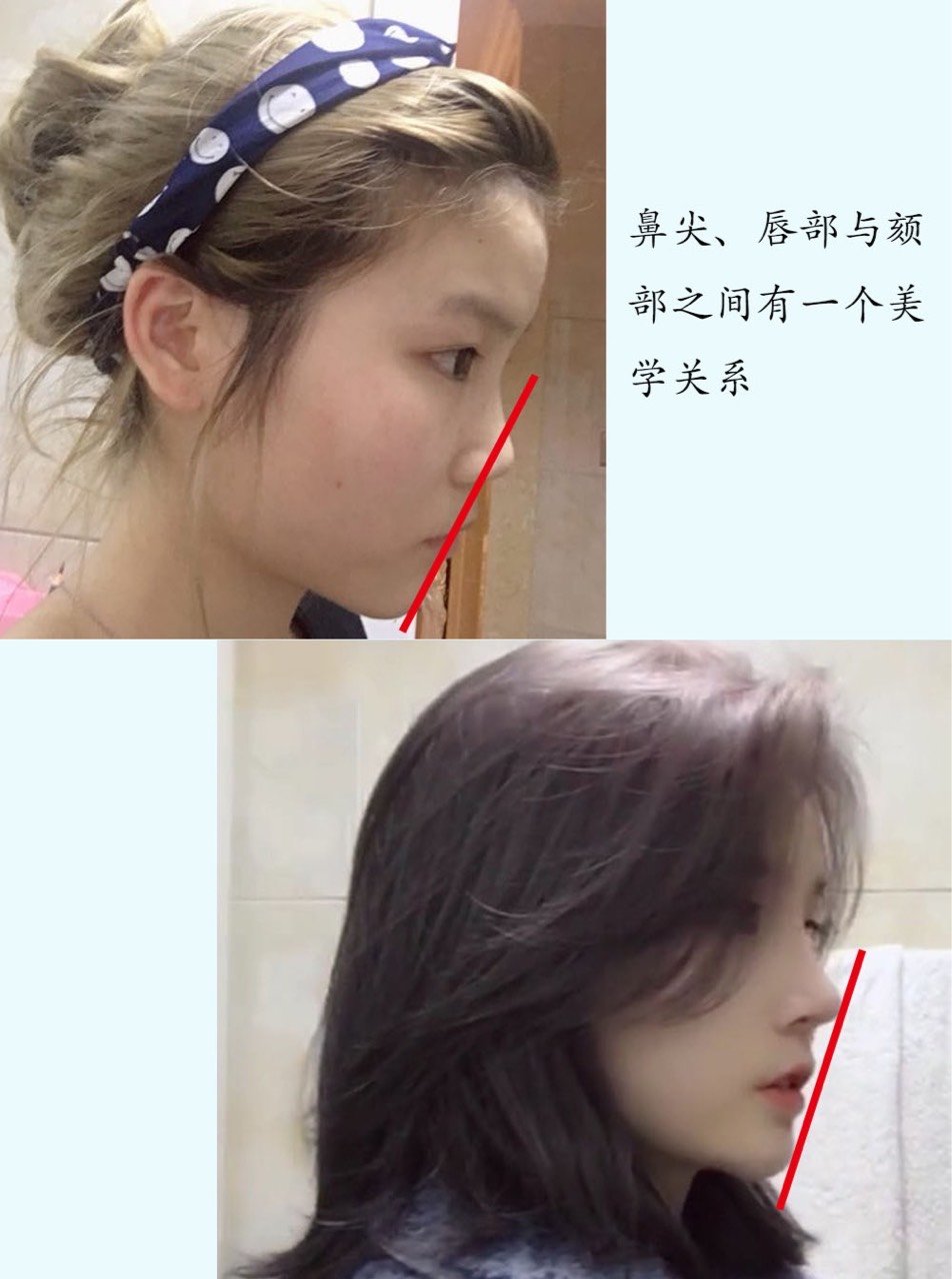 求美者露露 手术项目:鼻中隔延长 肋软骨 鼻头鼻翼缩小 案例解析　