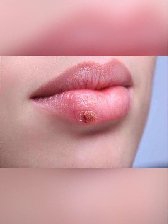 拿常见的口唇起疱来说,口唇疱疹,又称单纯疱疹,由单纯疱疹病毒(hsv-1)