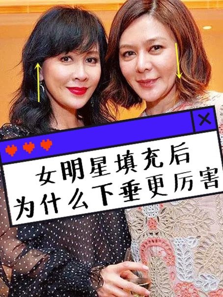 为什么很多女明星填充后,会有【过度】的感觉?