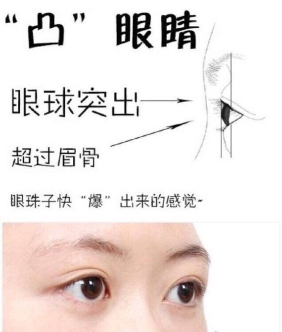 眼球突出是很多亚洲人的特点,眼球突出的原因主要有两个