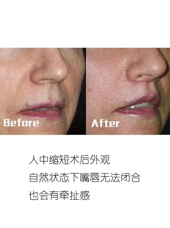 中庭过长有必要做人中缩短吗?
