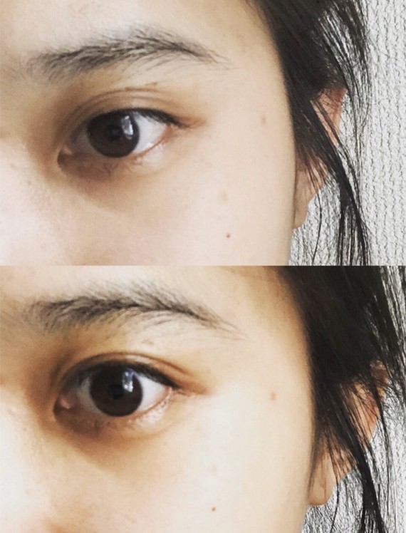 做完双眼皮手术后眼睛变成三眼皮~这是什么情况呢?