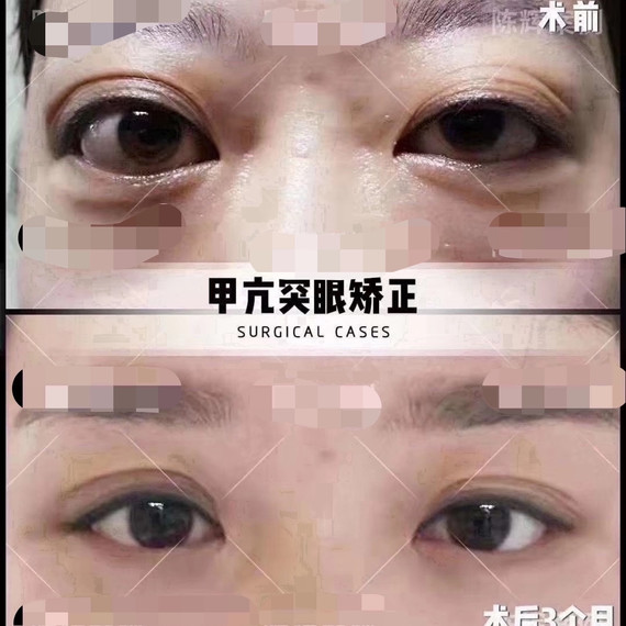 甲亢凸眼成功案例如果凸眼已经影响到你的生活那么可以_圈子-新氧美容