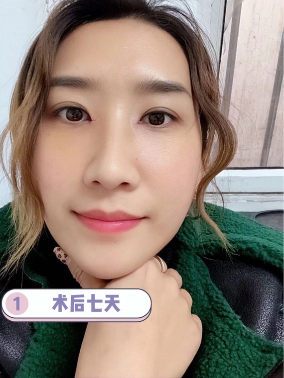 不建议做内眼角因为做完会回缩眼整形医生来告诉你实情