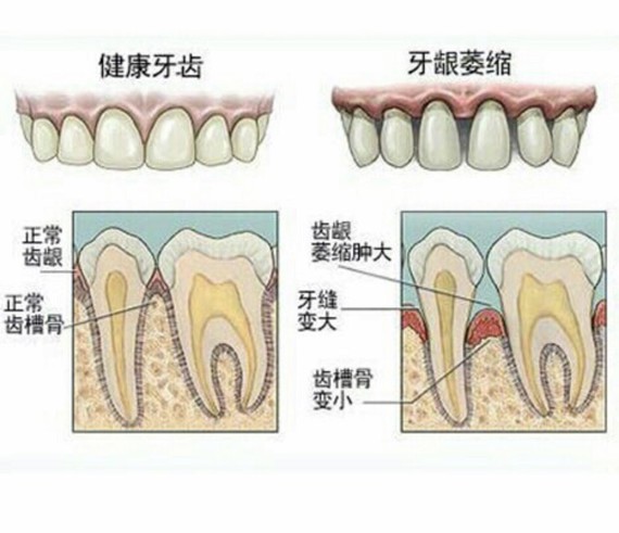 牙龈易出血?不是上火,,是牙周病!