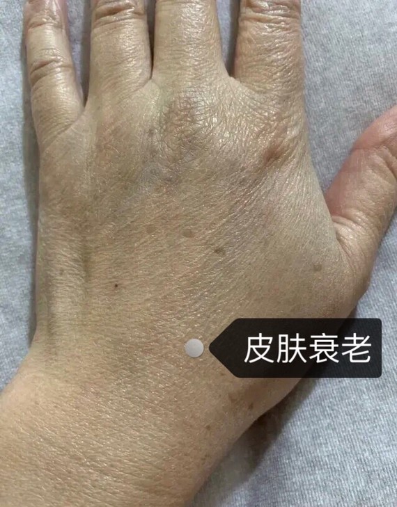 这个手背是典型的老年斑,也叫脂溢性角化病,是皮肤衰老的表现.