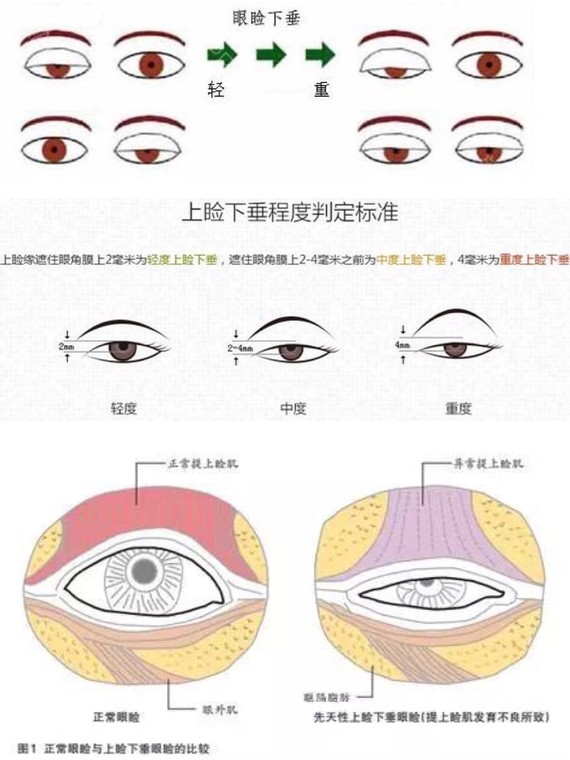 造成上睑下垂的病因都有哪些呢?