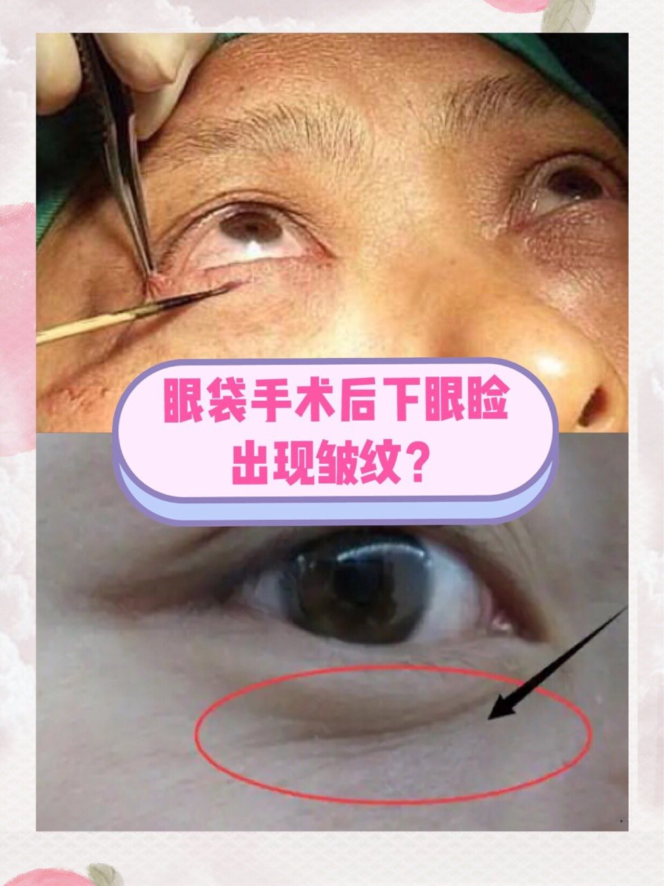 眼袋手术后下眼睑出现皱纹?