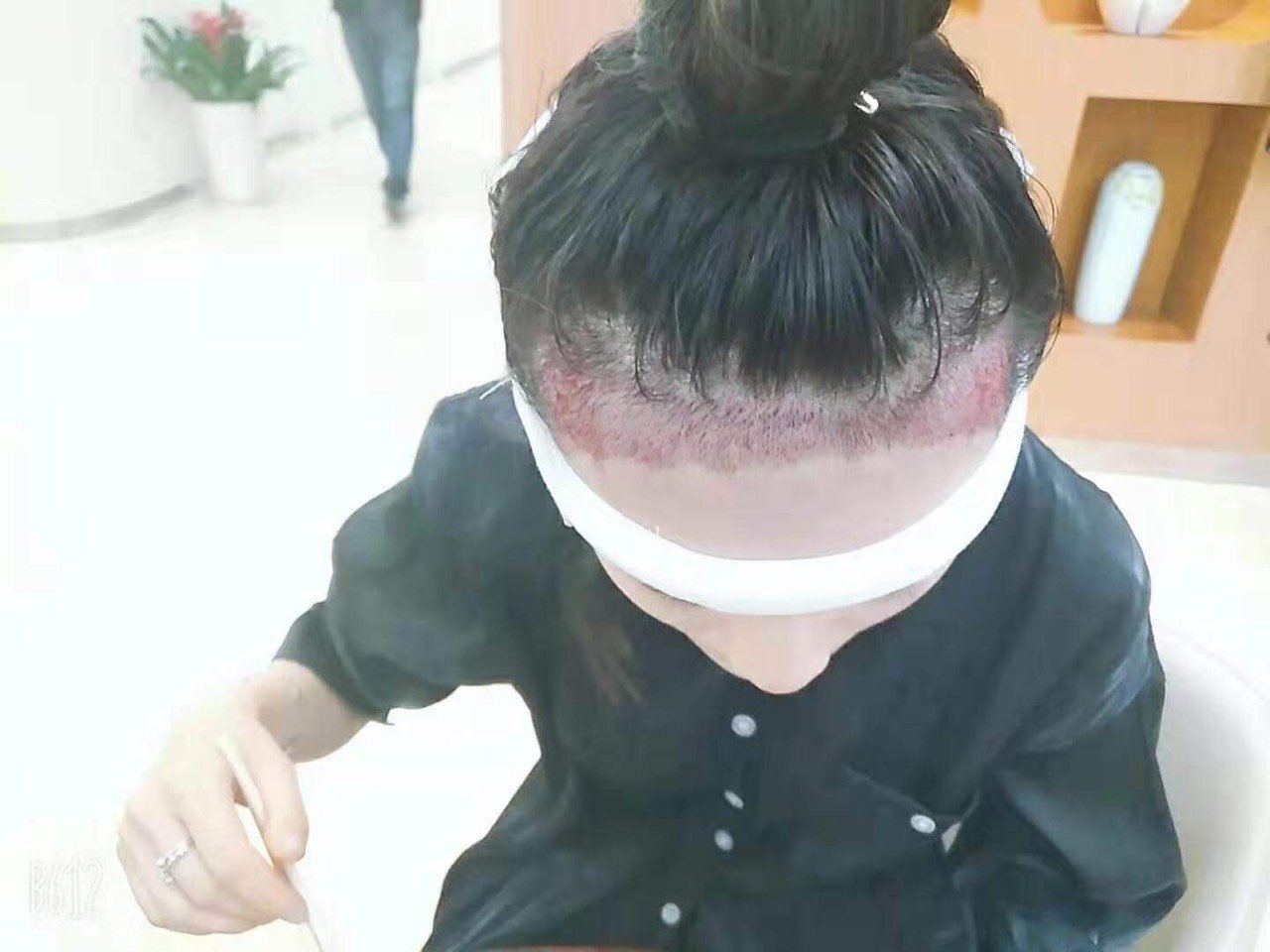 美女模特通过新氧咨询来找我植发了,图9是我哦_圈子-新氧美容整形