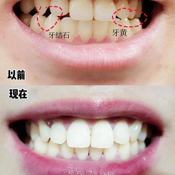 【牙齿白,涂什么口红都好看呀】亲亲们还在为牙黄而担