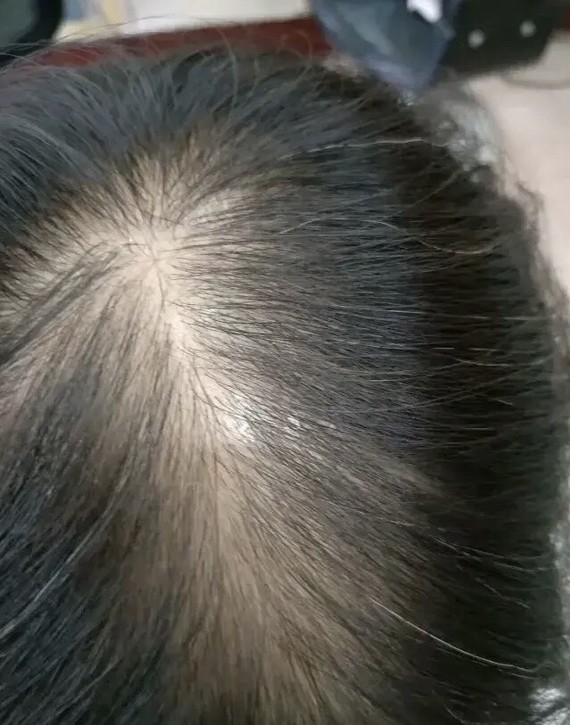 女性的雄激素性脱发,一般发际线不改变,只是头顶的头发稀疏.