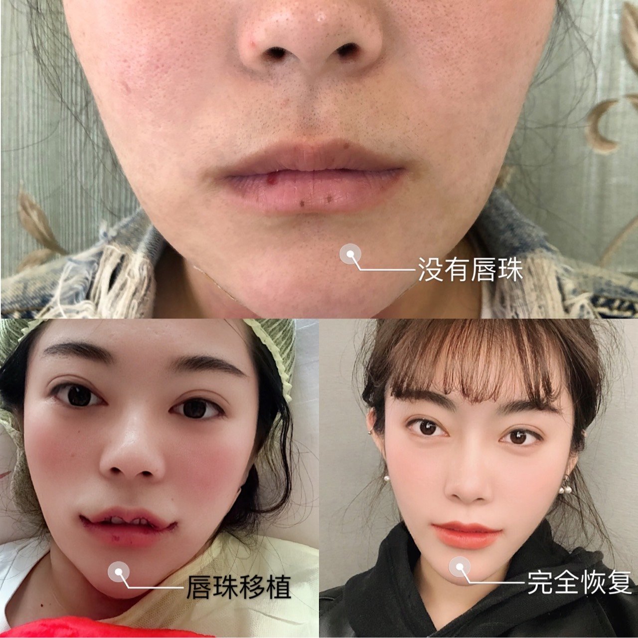 拯救完美唇珠计划#琦琦本来是没有唇珠的,但是又很喜欢,手术来帮我