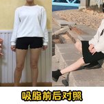 想要"铅笔腿",瘦腿针和抽脂瘦腿该怎么选  拥有健康细长的小腿是很多