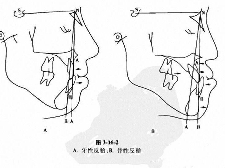 的面部根据区域的不同分为直面型,微凸面型,凸面型以及凹面型(图2)