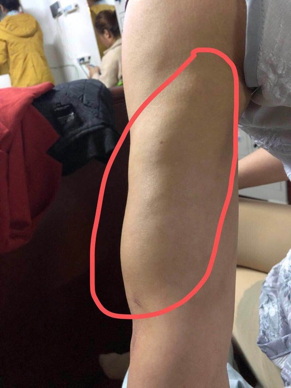 术后一星期拆线的时候就发现左手臂手肘的位置有个包,后面随着恢复期