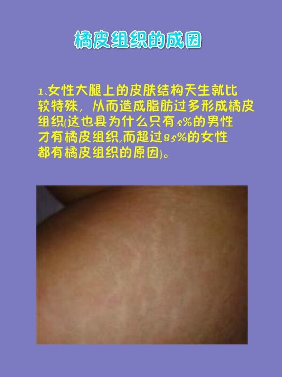 美容师热衷于兜售治疗橘皮组织的产品,宣称能够让女性的大腿恢复苗条