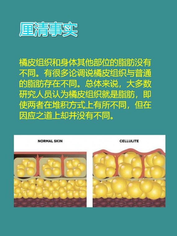 橘皮组织(又称大腿浮肉)是一一个普遍的美容问题,用专业术语来说就是