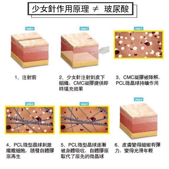 最近,有美妆博主说少女针就是玻尿酸填充物,是水光