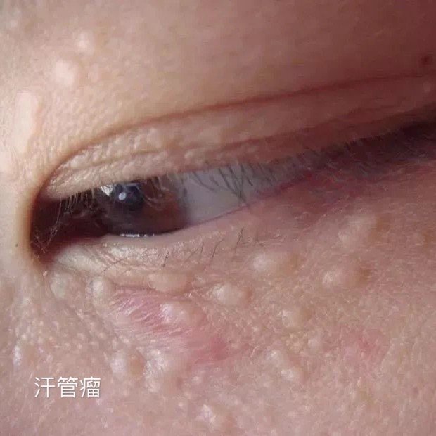 1脂肪粒 在皮肤科中,我们一般会叫"脂肪粒"为粟丘疹,它酶跟脂肪