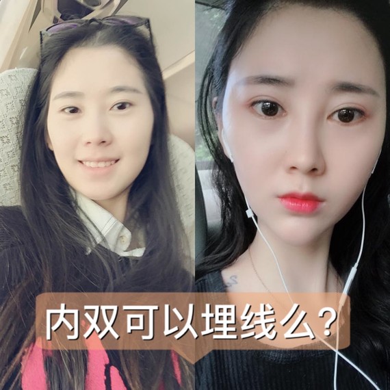 内双是可以做埋线双眼皮的,显得较为自然.