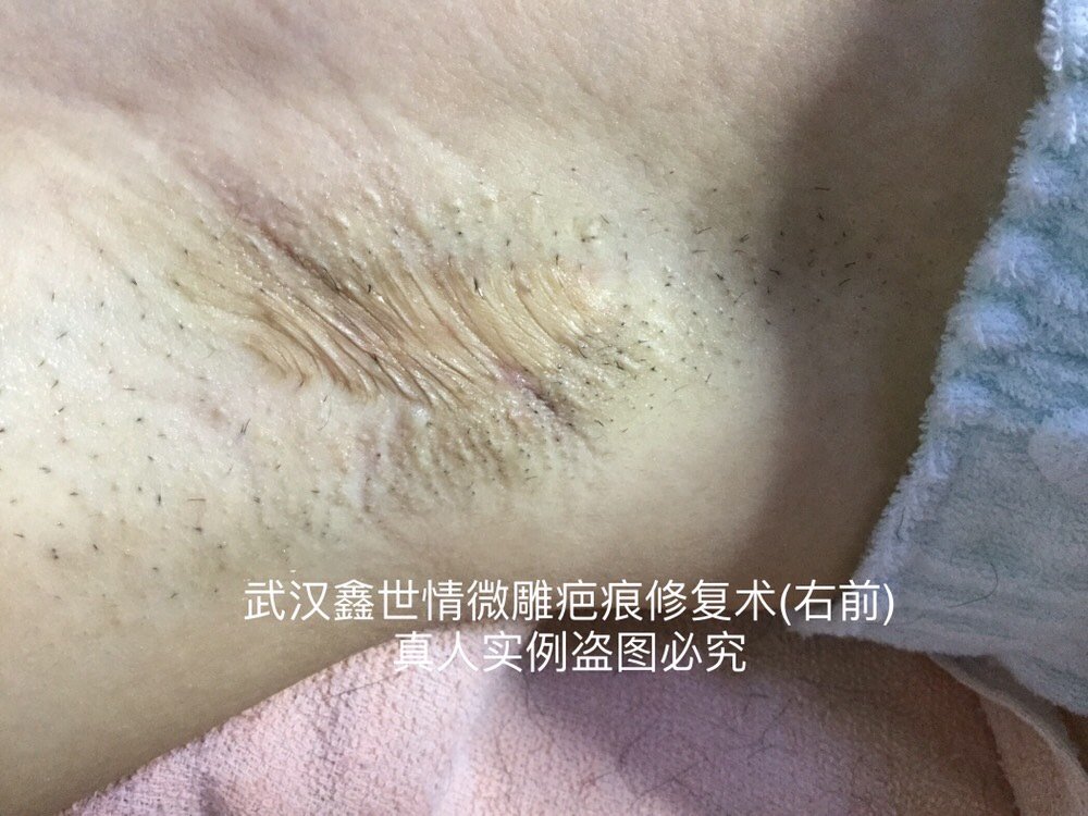 腋下手术后疤痕,湖北武汉客户