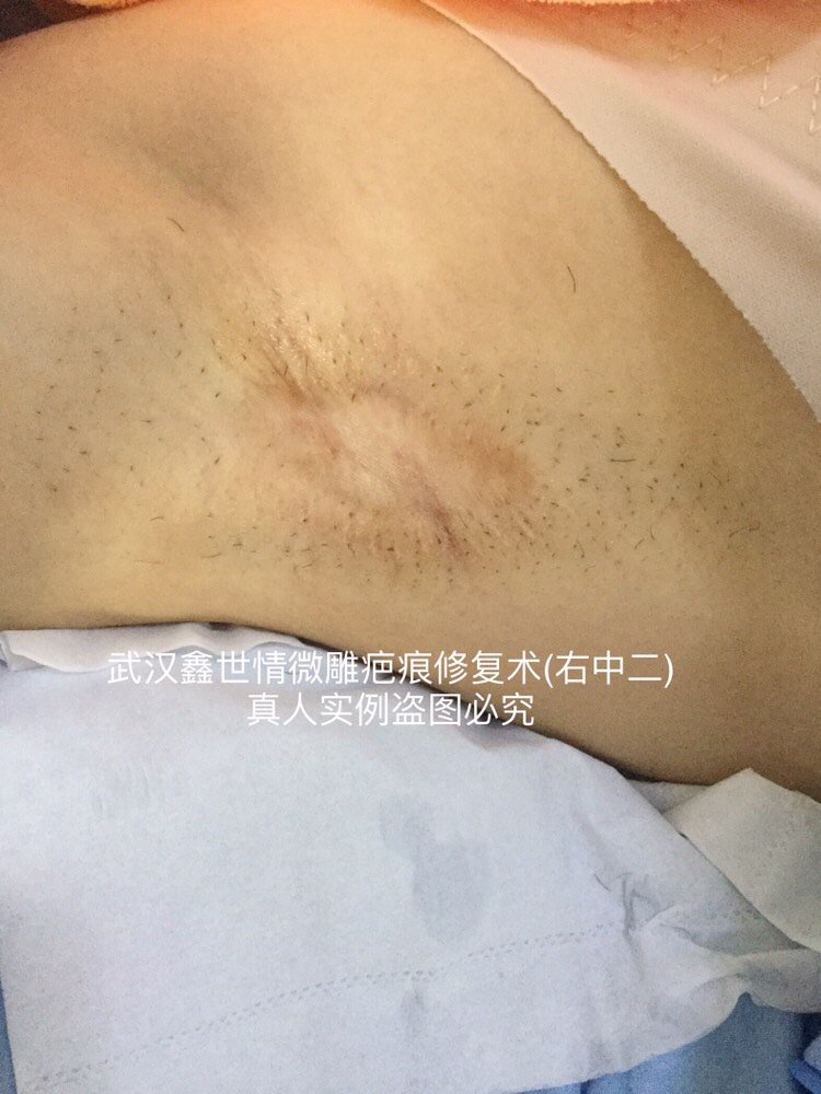 腋下手术后疤痕,湖北武汉客户