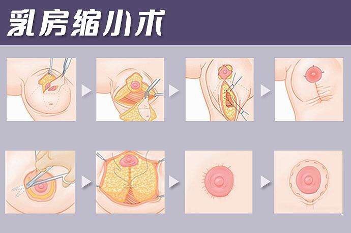 乳头缩小术会影响哺乳吗?乳头缩小手术使得很多的女性
