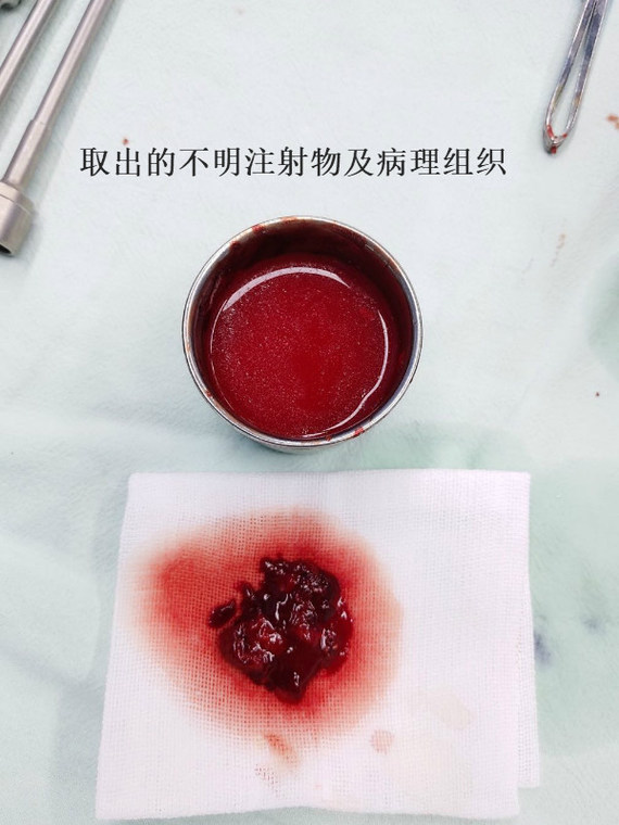 不明注射物取出实录——经济与实惠,往往难以兼得!