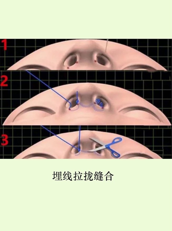 鼻翼缩小手术可以去除多余的组织,使鼻基底部缩窄,鼻孔缩小,是鼻部多