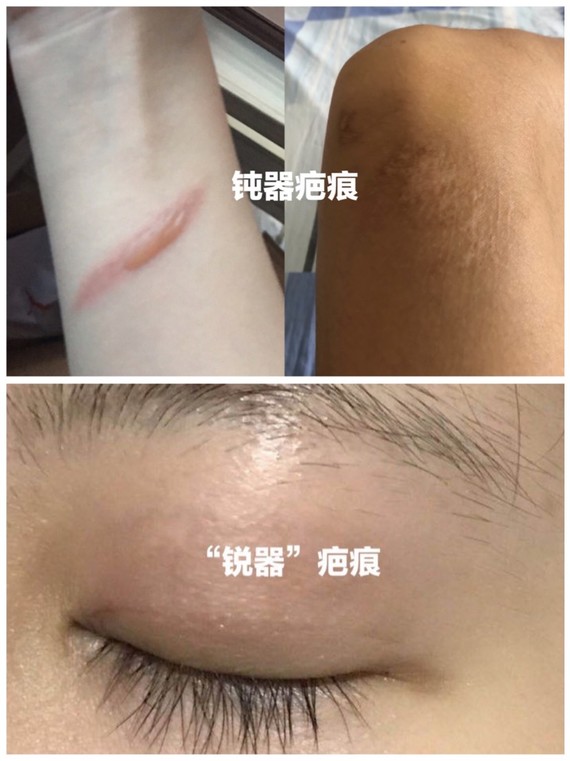 面部拉皮手术瘢痕到底重不重?很多人都知道,对于中老
