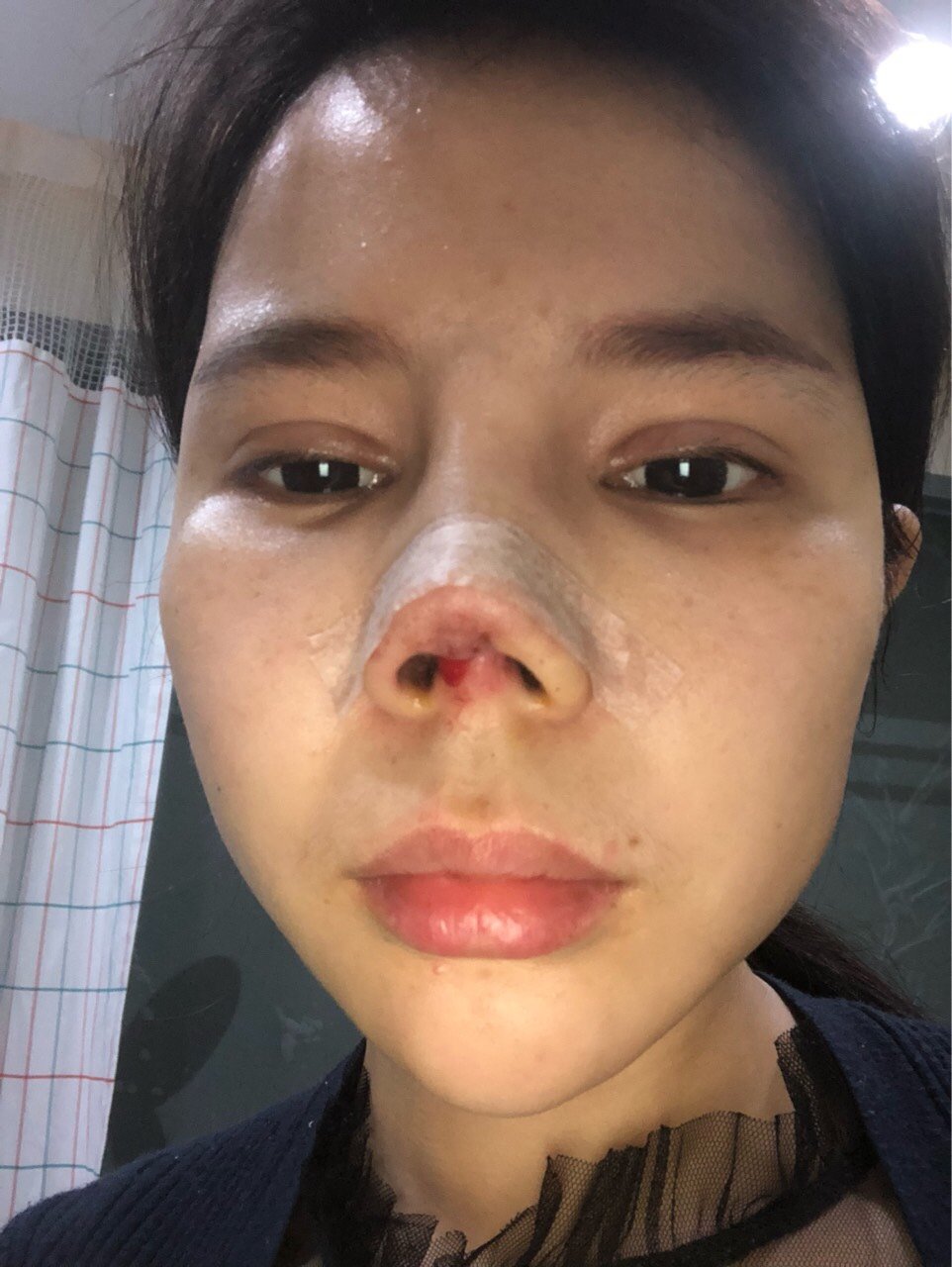 排了两天,鼻子不肿了,后面假体上移到眉毛,鼻头假体顶出来,4月24号我