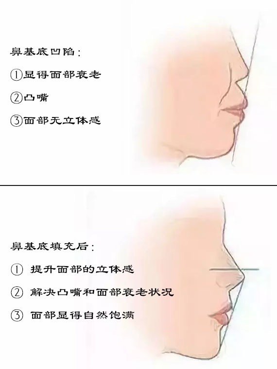 鼻基底填充手术为什么比较少单独做?