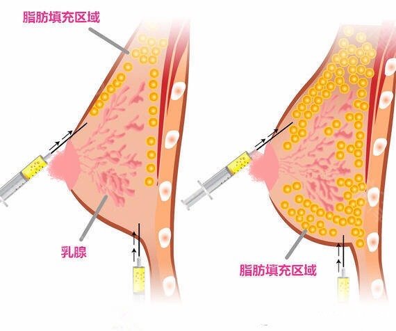 复合隆胸:假体 自体脂肪