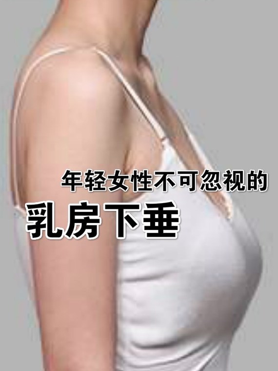 年轻女性不可忽视的乳房下垂!