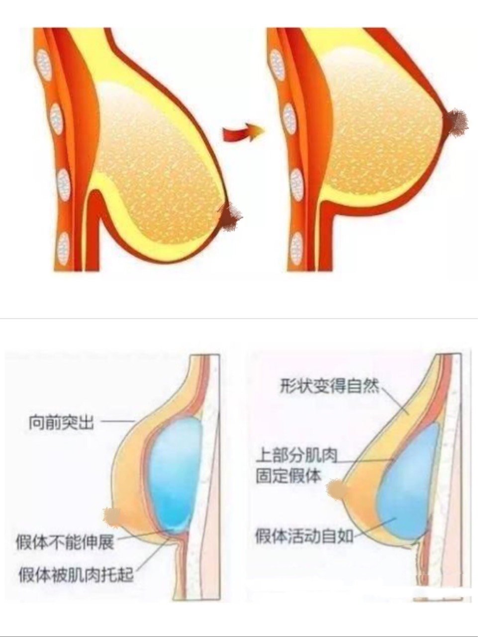 乳房下垂,还能做假体丰胸吗?